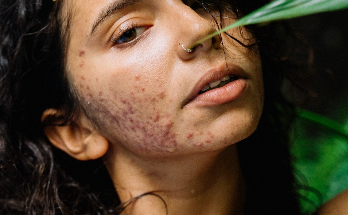 teenage acne