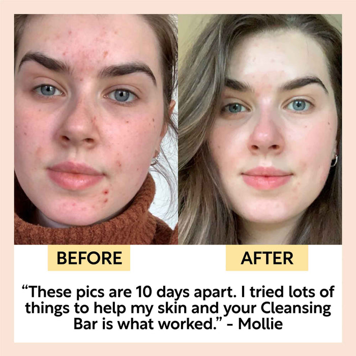 product image-3,Acne-Prone Skincare Bundle