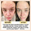 product image-7,Acne-Prone Skincare Bundle