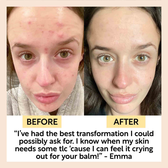 product image-7,Acne-Prone Skincare Bundle