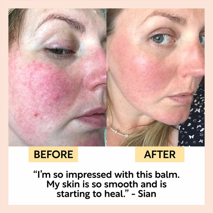 small product image-7,The Dry Skin Bundle