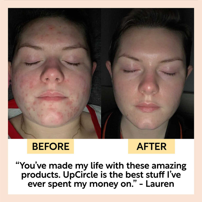 small product image-5,Acne-Prone Skincare Bundle